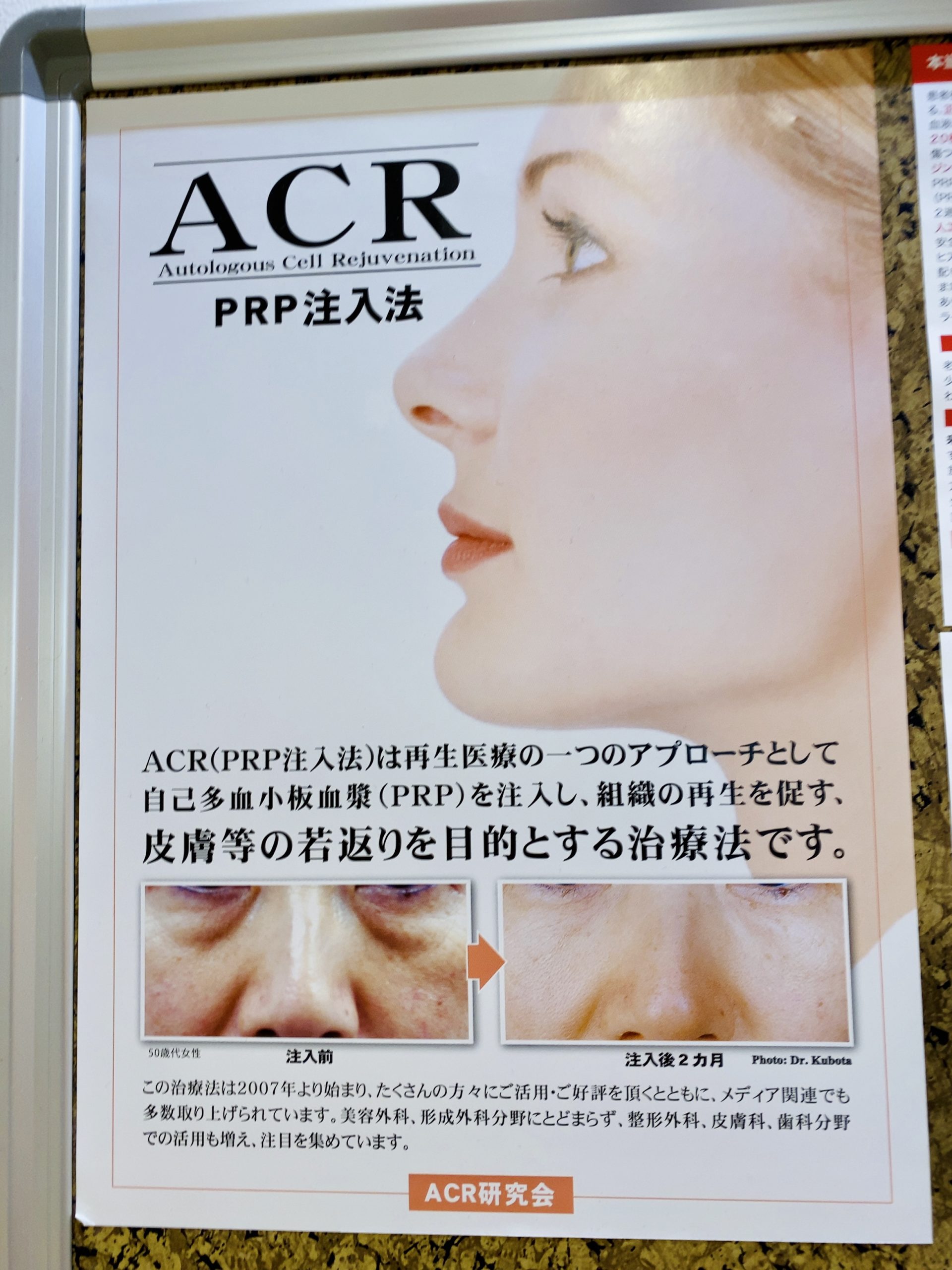 再生医療PRPとフラクショナルレーザーで美容皮膚科デビューしてみた②